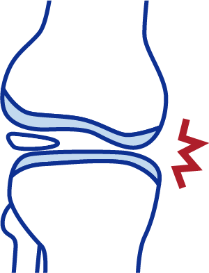 関節軟骨がすり減り、関節のすき間が狭くなる