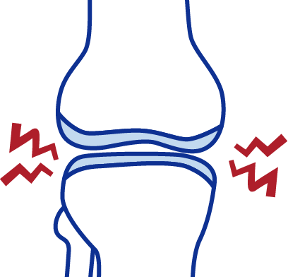 関節軟骨がほぼなくなって、骨と骨が直接ぶつかる