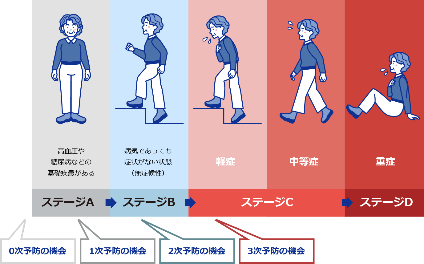 心不全のステージ分類