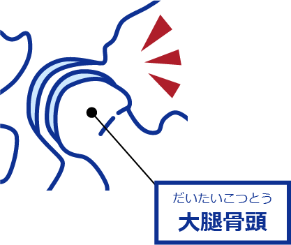 大腿骨頭と骨盤の隙間に狭いところが出てくる