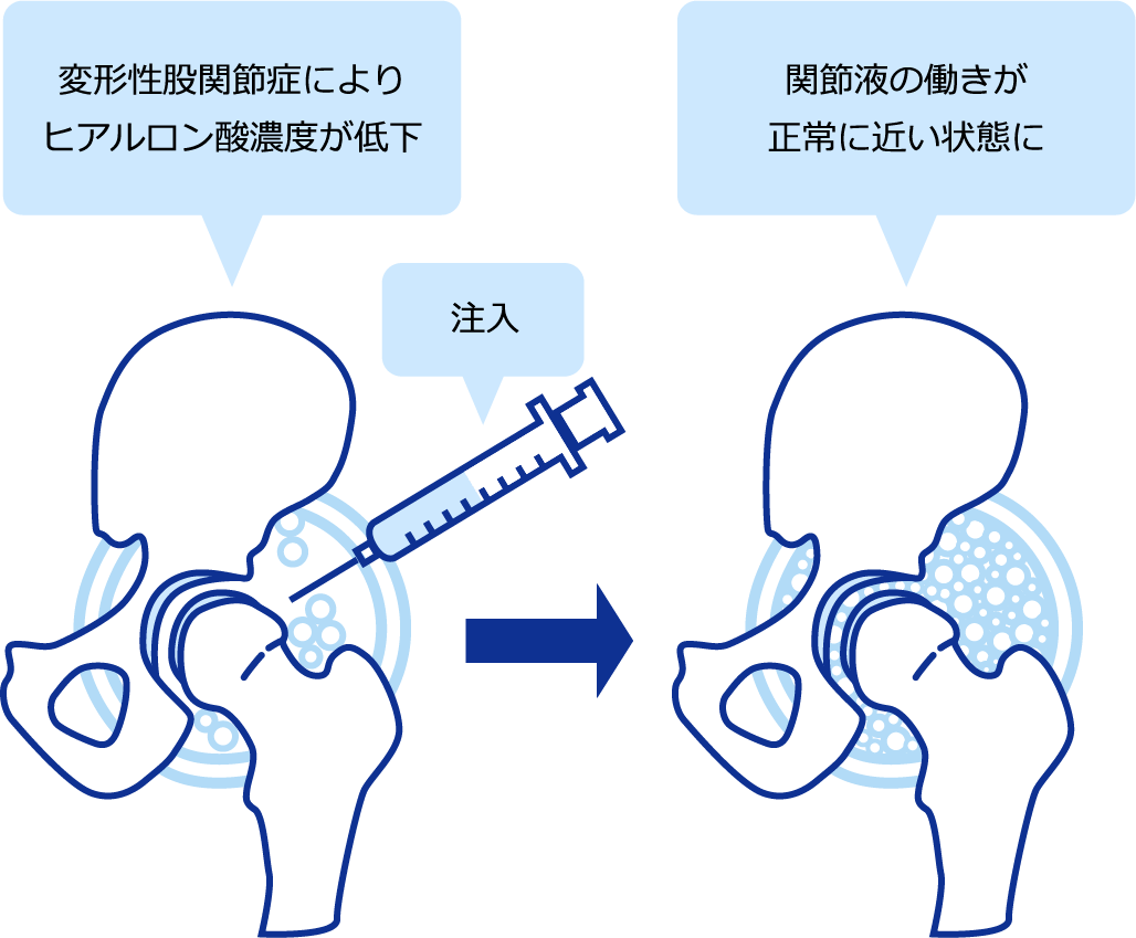関節内注射を注入すると関節液の働きが正常に近い状態になる
