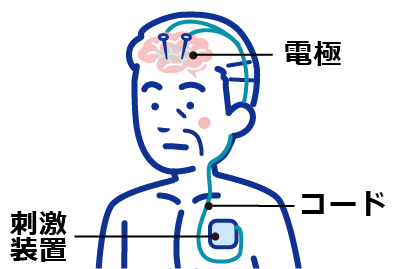 脳深部刺激療法（DBS）